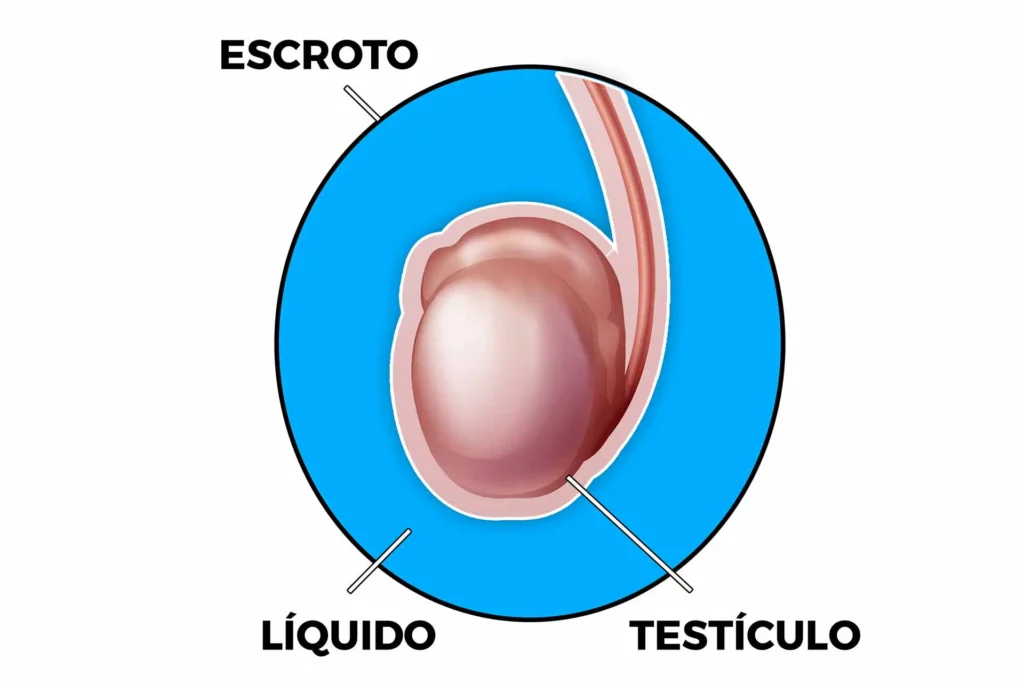 cirurgia de hidrocele testicular, foto com escroto, líquido e testículo