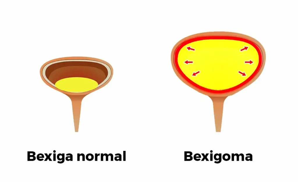 antes e depois de uma bexiga com bexigoma com uma dilatação intensa e aumento da sua pressão interna